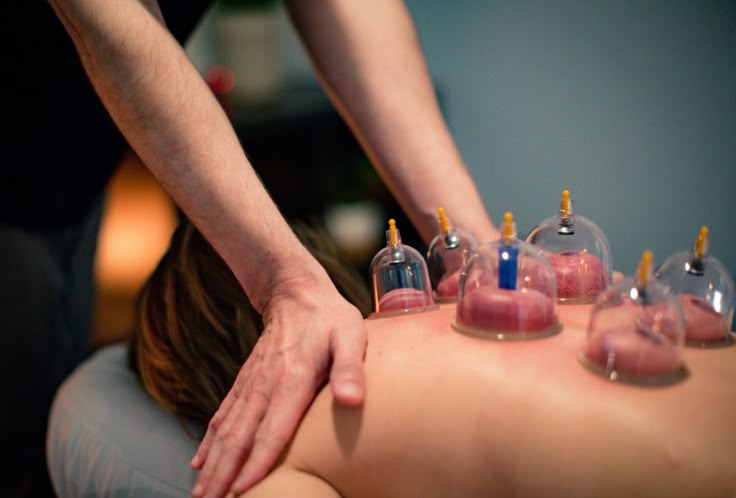cupping therapy
