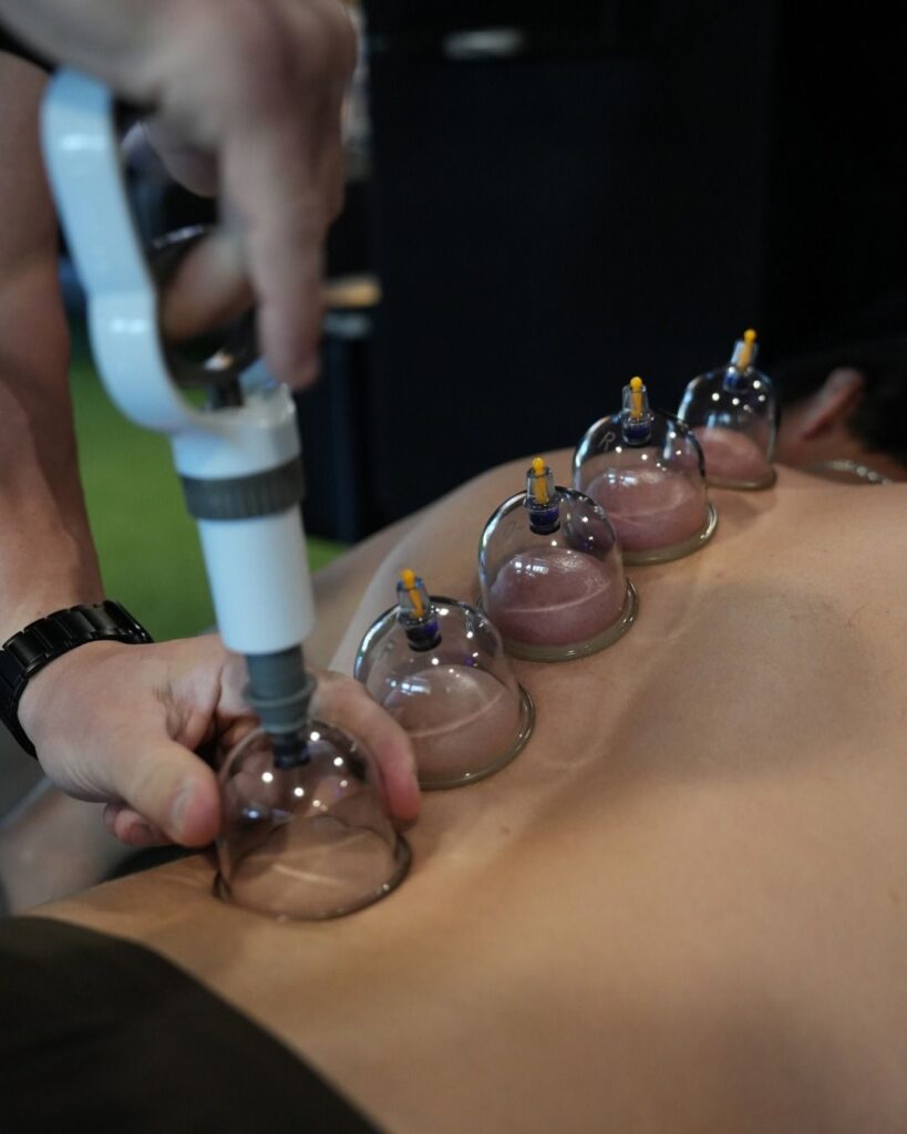 cupping Therapy